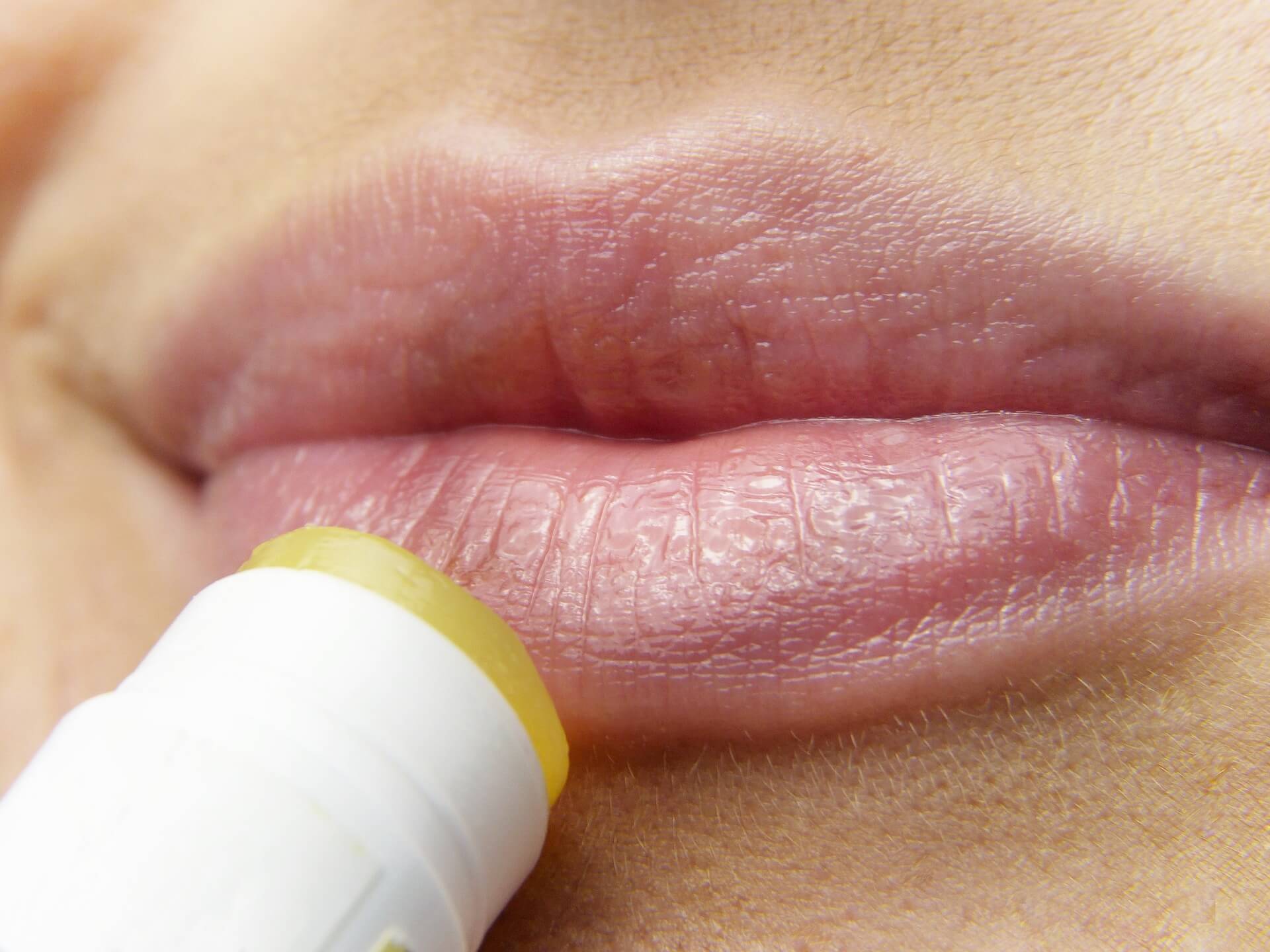 Opryszczka na ustach – przyczyny, objawy, leczenie i powikłania. Czy można się nią zarazić?